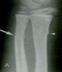 RX fractuur metafyse